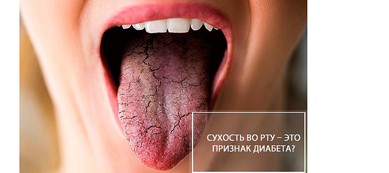 Сухость во рту – это признак диабета?
